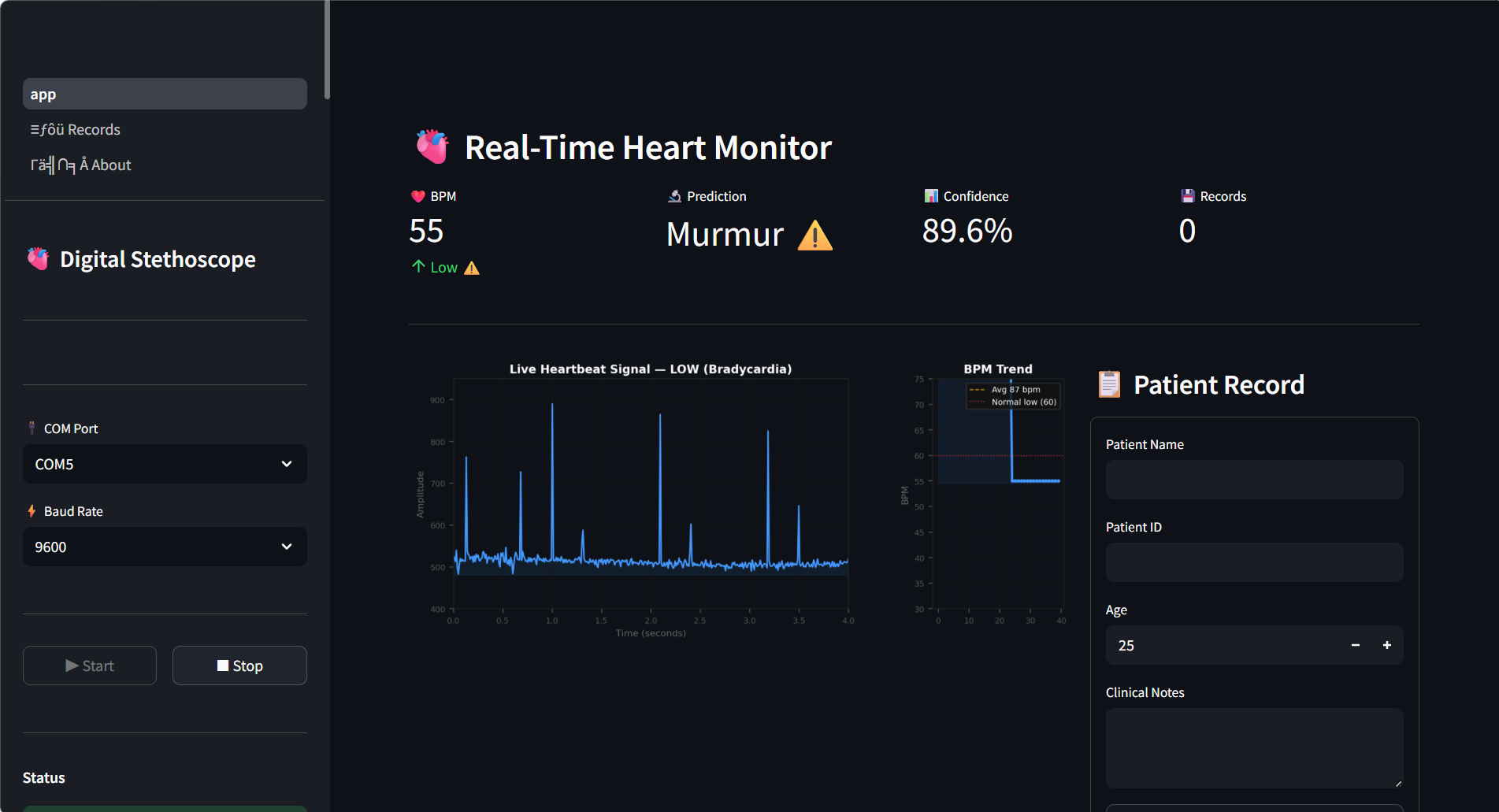Fig. 5b: Streamlit dashboard showing abnormal heart sound classification with murmur prediction (Panel B).